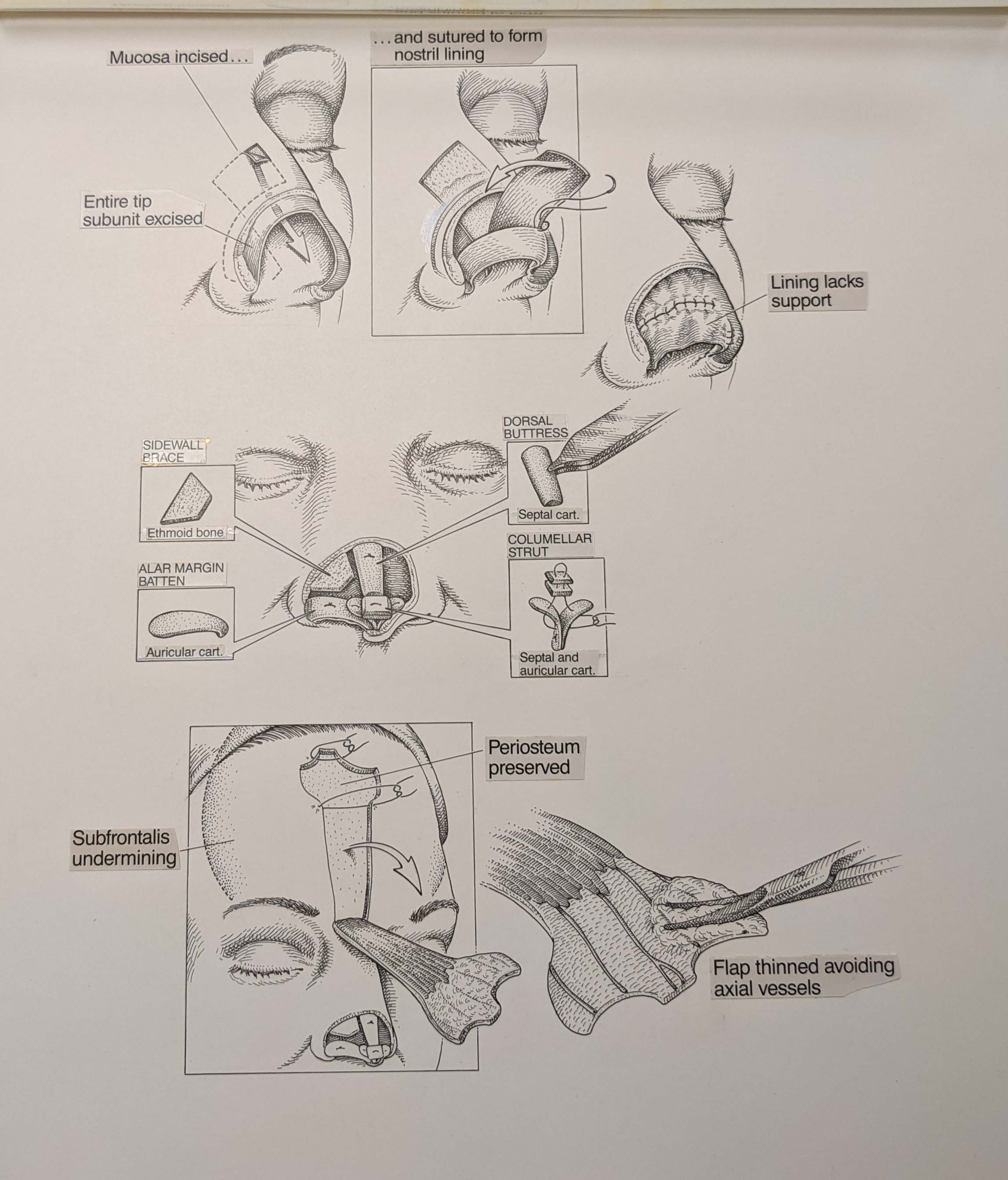 black and white medical illustration of a facial reconstruction