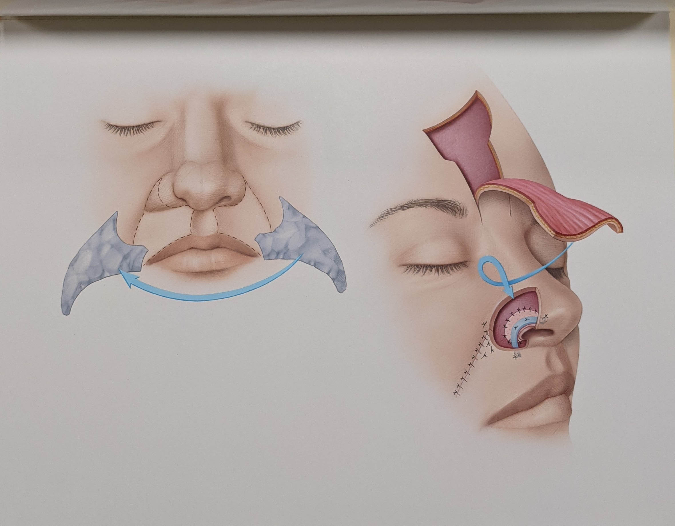 medical illustration of a white person's face being reconstructed